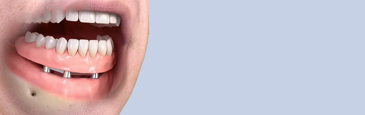 dental implant overdenture