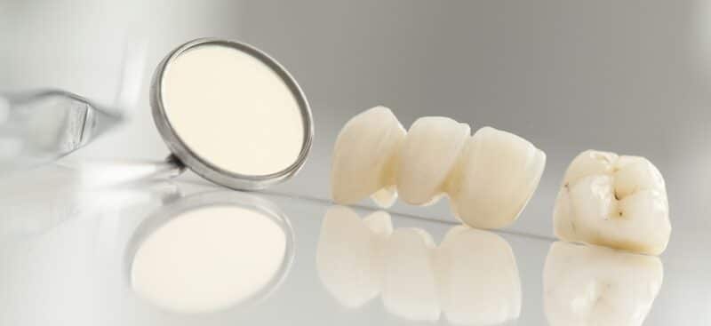 Dental Crown Treatment Procedure