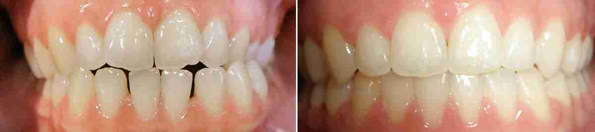 open bite dental braces